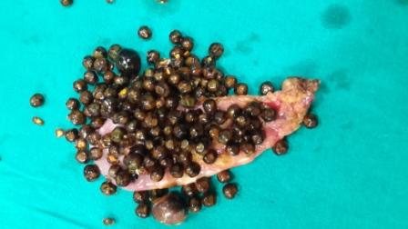 GALL BLADDER STONE